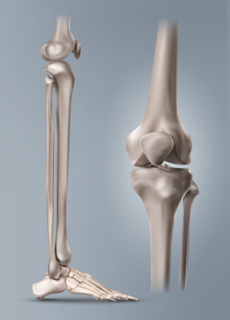 Knee Replacement