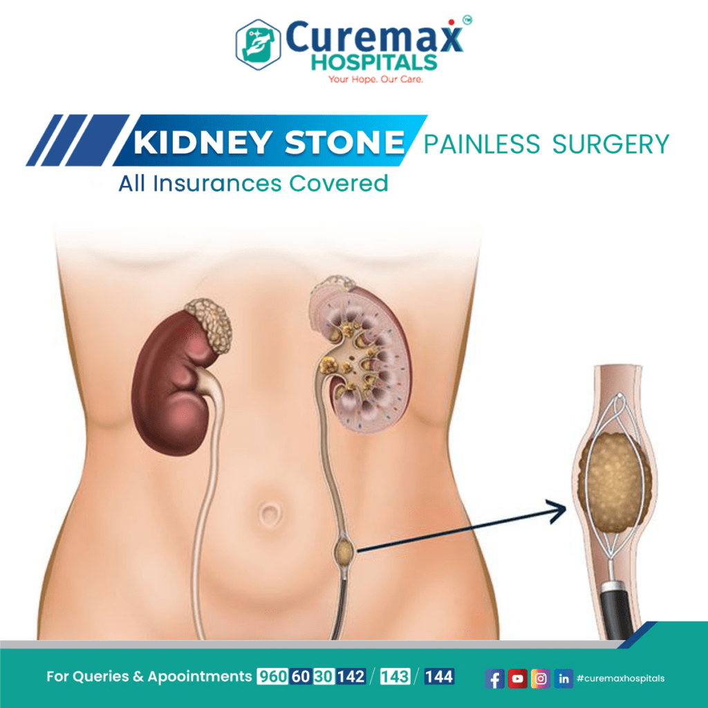 Signs That You Might Be Living With Kidney Stones